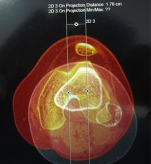 Resim 2: Tibial tüberkül-troklear oluk mesafesinin ölçülmesi
