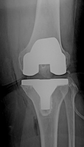 Figure 1a: The entire joint surface is replaced in total knee arthroplasty. 