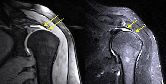 Figure 3: Arrows point out the location of a full thickness tear on MRI images.