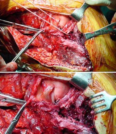 Çoklu bağ yaralanmasında, dikiş kancaları ile açık lateral menisküs tamiri