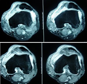 Resim 1: Akut patella çıkığında MPFL'nin femoral insersiyonundan kopması