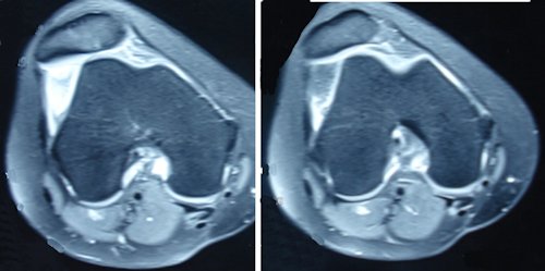 Resim 3: Akut patella çıkığı sonrası patellar subluksasyonun devam etmesi 