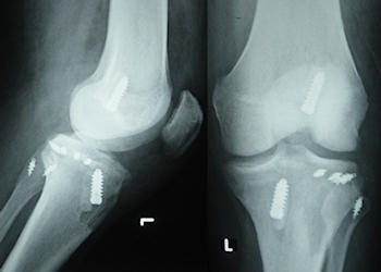 Ameliyat sonrası grafiler; fibula başına iki, tibia platosuna 4 adet dikiş kancası ile tespit yapılmış Ameliyat sonrası grafiler; fibula başına iki, tibia platosuna 4 adet dikiş kancası ile tespit yapılmış