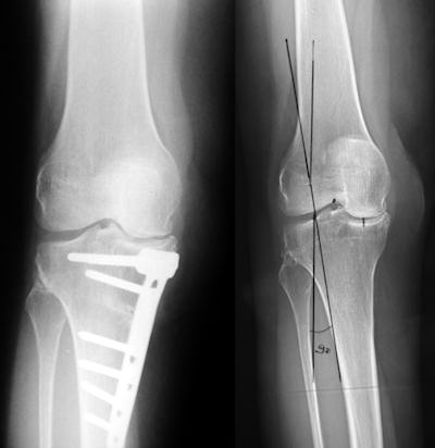 Bacakta eğrilik nedeniyle dizin iç bölümünde aşınma olan hastada kemik düzeltici ameliyat (osteotomi). Bacaktaki eğrilik düzeltilmiş ve yük hasarlı bölgeden sağlam bölgeye aktarılmış.