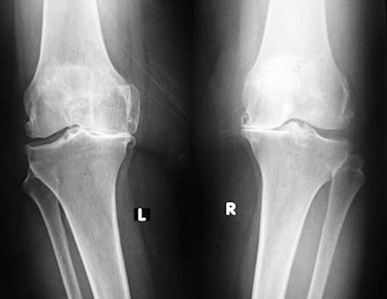 Röntgen grafilerinde diz artrozu, eklem mesafesi kaybolmuş ve kemikler birbirlerine sürtünüyor