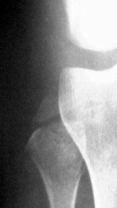 Fibula başından avülziyon kırığı Fibula başından avülziyon kırığı