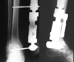 Unilateral eksternal fiksatör ile artroskopik ayak bileği artrodezi