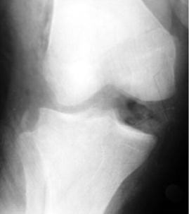 Diz çıkığının radyolojik görünümü, medial açılma ve lateralde tibia platosundan avülziyon kırığı