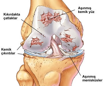 Diz ekleminde artroz