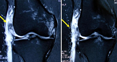 Femoral taraftan lateral yapıların avülziyonu