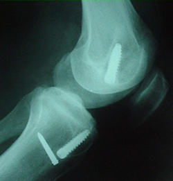 Anterior yerleşimli femoral ve tibial tünel Anterior yerleşimli femoral ve tibial tünel