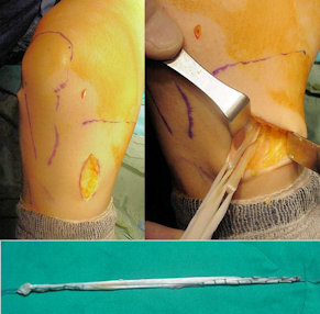 Hamstring tendonlarının alınması Hamstring tendonlarının alınması