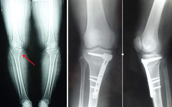 Picture 1: An osteotomy is performed to correct the bowing of the knee and unload  the involved compartment