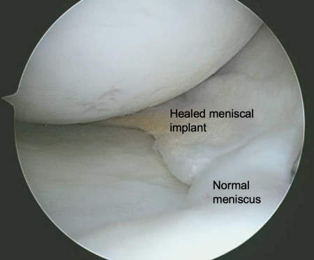 Picture 2: Arthroscopic view of a healed meniscal implant performed for partial loss of the meniscus
