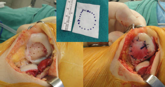 Picture 3: Cartilage restoration in the knee using a collagen matrix implant.