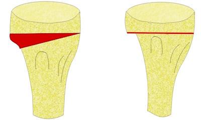 Kapalı kama osteotomisinin şematik görünümü Kapalı kama osteotomisinin şematik görünümü