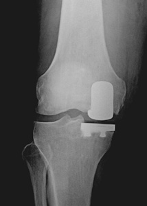 Figure 1b: Only the diseased compartment of the knee is resurfaced in partial (unicondylar) knee arthroplasty.