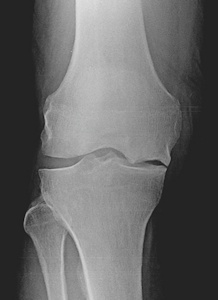 Figure 3a: X-ray demonstrating collapse of the bone on the inner part of the femur. The rest of the joint is normal.