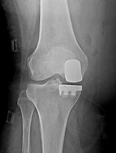 Figure 3b: X-ray after surgery depicting the resurfacing of only the involved side of the knee.