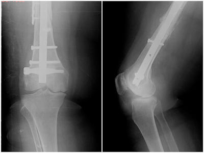 Figure 4a : A patient with a nail and plate on the femur bone, with osteonecrosis on the inner side of the femur. Figure 4a : A patient with a nail and plate on the femur bone, with osteonecrosis on the inner side of the femur.