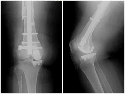 Figure 4b: the patient is treated with a partial knee replacement without removing the implants in and on the bone. Figure 4b: the patient is treated with a partial knee replacement without removing the implants in and on the bone.