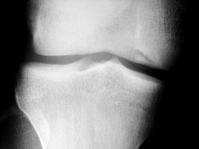 Osteocondrita disecanta