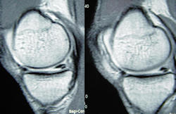 MRG’de iç menisküs yırtığının görüntüsü