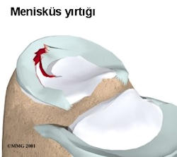 Menisküs yırtığının şematik görünümü