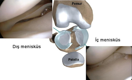 İç  ve dış menisküsün şematik ve artroskopik görüntüleri, iç menisküste yırtık izlenmekte