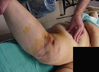 Obez hastada açık diz çıkığı Obez hastada açık diz çıkığı