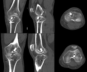 Resim 4a: Bilgisayarlı tomografi görüntülerinde tünel genişlemesi.