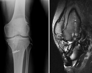 Resim 4c: Revizyon ön çapraz bağ cerrahisi sonrası röntgen ve MR görüntüleri.
