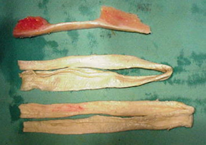 Resim 5a,b: Revizyon ön çapraz bağ cerrahisi sırasında kullanılan yumuşak doku ve kemik allogreftleri.
