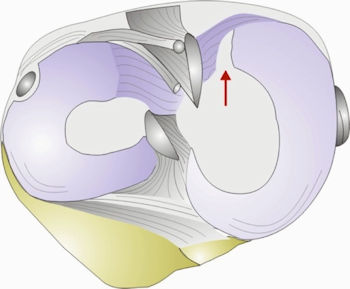 Resim 1: İç menisküs kök yırtığının şematik görünümü. Resim 1: İç menisküs kök yırtığının şematik görünümü.