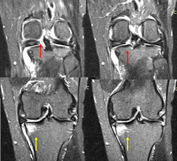 Figure 2: MR images of a medial meniscal root tear. Red arrows: Separation of meniscus from its boney insertion. Yellow arrows: Bone marrow edema adjacent to the tear. 