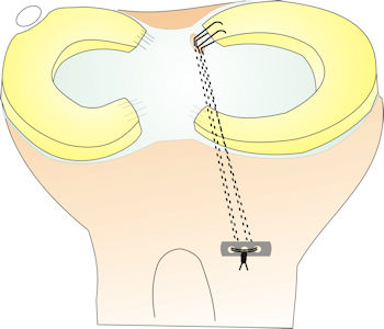Figure 3 : Meniscal root repair is performed by passing sutures through a bone tunnel, and tying these over a small metal implant over the tibial bone.