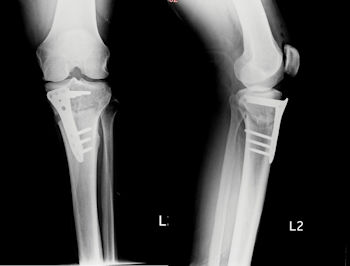 Figure 4: Combination of a medial meniscus root repair with an osteotomy to correct the limb alignment. A titanium plate and screws are used to fix the bone after a corrective bone cut.