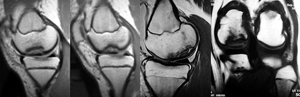 Osteokondritis dissekansın MR görünümü