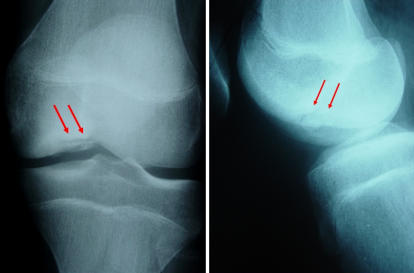 Resim 1 : Diz ekleminde klasik yerleşimde osteokondritis dissekans’ın röntgen görüntüsü.