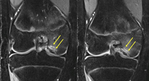 Resim 2: Daha önce biyobozunur vida ile tespit yapılmış ancak iyileşme sağlanmamış bir hastanın MR görüntüleri.
