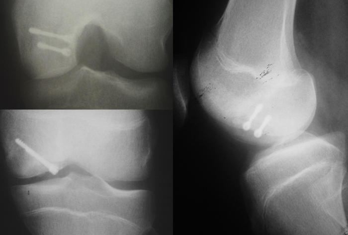 Figure 4: An osteochondritis dissecans fragment fixed with 2 metal screws. 
