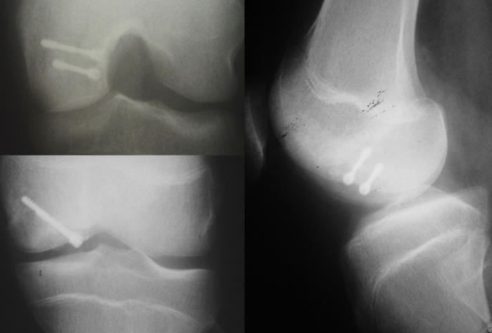 Resim 4: Metal vidalar ile  tespiti sağlanmış osteokondritis dissekans.