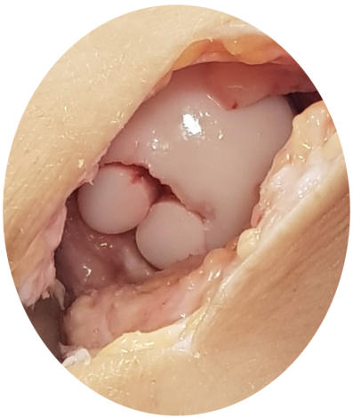 Figure 5: An osteochondritis dissecans treated with mosaicplasty. The surface contour has been restored with living bone and cartilage. 