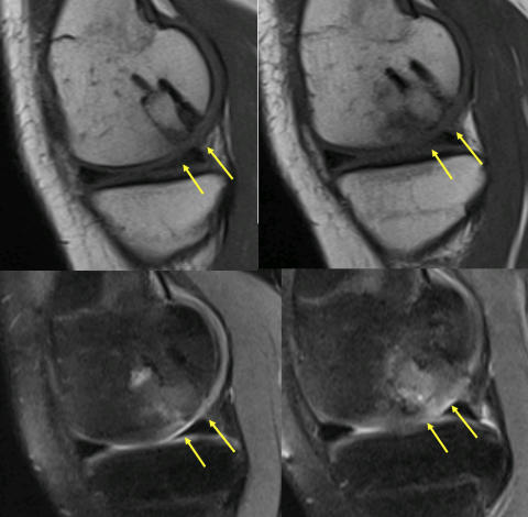 Figure 6: MRI’s of a patient 6 months after mosaicplasty. The transplanted plugs have healed to the adjacent bone and the contour of the joint surface has been restored. 