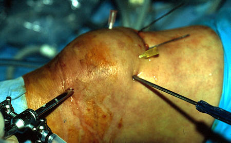 Artoskopik patella kırığı tedavisi Artoskopik patella kırığı tedavisi