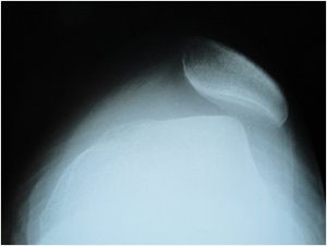 Resim 1: Röntgen grafisinde patella yarı çıkık durumda görünmekte.