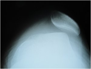 Resim 1: Röntgen grafisinde patella yarı çıkık durumda görünmekte. Resim 1: Röntgen grafisinde patella yarı çıkık durumda görünmekte.