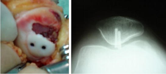 Resim 2 : Patella çıkığı sonrası oluşan kıkırdak kopması vidalar ile tespit edilmiş