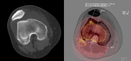 Resim 3: Patella çıkığında MRG ve tomografi ile yapılan hassas ölçümler sonrası cerrahi planlanır. Resim 3: Patella çıkığında MRG ve tomografi ile yapılan hassas ölçümler sonrası cerrahi planlanır.