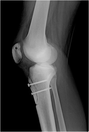 Figure 4 : X-ray of a patient who underwent a combined surgery for patellar instability. MPFL reconstruction has been performed with tunnels in the patella and femur. The pull of the quadriceps muscle has been modified using a tibial tubercule osteotomy and fixed with 2 metal screws.